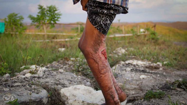 Assaria is a 9-year-old kid who burned 20% of his body at the beginning of 2021