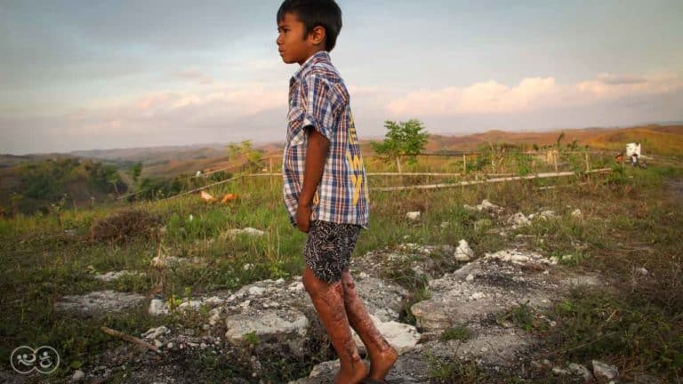 Assaria is a 9-year-old kid who burned 20% of his body at the beginning of 2021