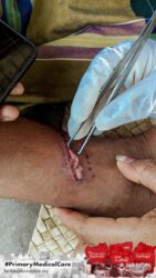 A health agent from Kawan Sehat is providing medical care to a patient in a remote village.