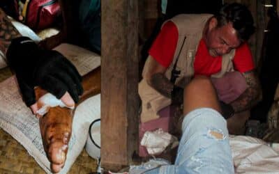 Snake Bite First Aid: Save Lives with Fast Action