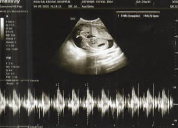 Ultrasound image showing a healthy 5-month pregnancy with a fetal heartbeat of 156 bpm, expected due date January 17th