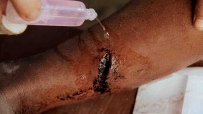 Early infection care to prevent sepsis • The Fair Future Foundation Early wound and infection care to prevent sepsis in rural Indonesia