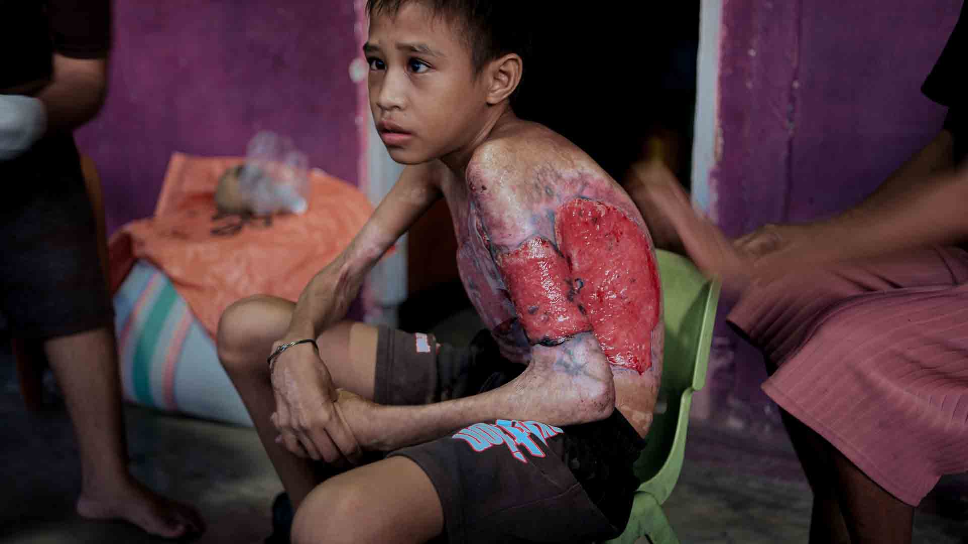 Swiss non-profit medical organisation working in ultra-rural indonesia Aldo, 14, with third-degree burns and contractures in East Sumba.