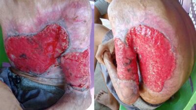 Two side-by-side images of a large, red, raw burn wound on the buttock and thigh with surrounding damaged skin.