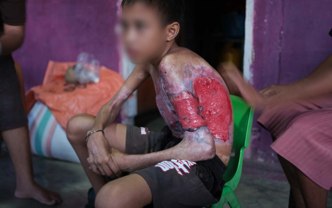 Third-Degree Burns Indonesia | Umbu Needs Burn Care