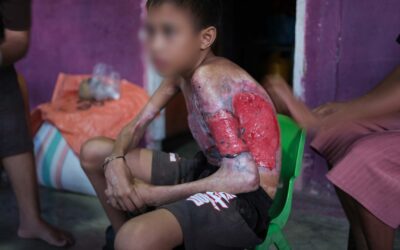 Third-Degree Burns Indonesia | Umbu Needs Burn Care
