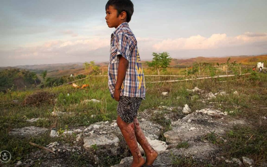 Assaria is a 9-year-old kid who burned 20% of his body at the beginning of 2021