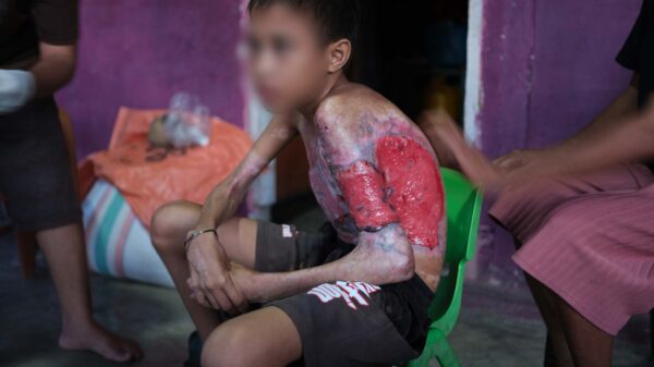 Boy with large burn injuries on his arm and shoulder sits on a green chair while people tend to him in a dim room outside a purple wall.