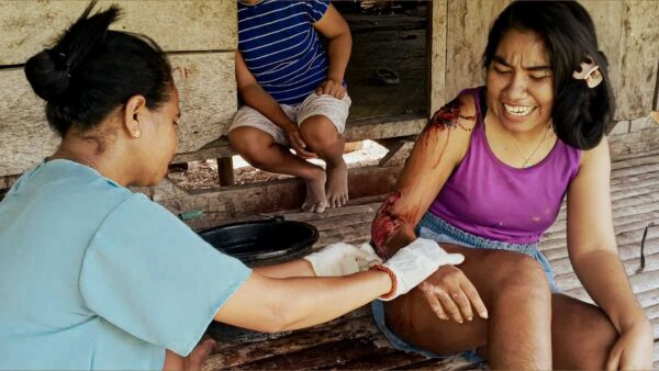 Kawan Sehat health agent treating a young woman with burns in rural East Sumba.